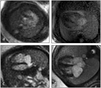 A comparative study of fetal cardiovascular assessment: utilizing Doppler ultrasound gated MRI and echocardiography with detailed analysis using five axial views